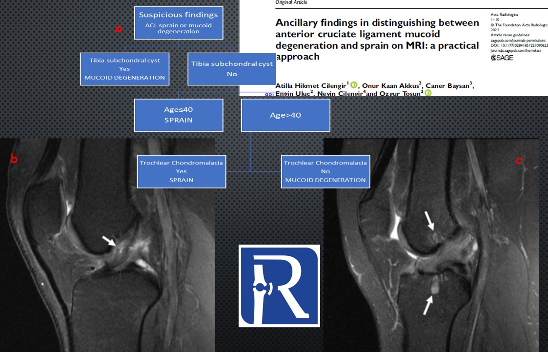 Ancillary findings in distinguishing between anterior cruciate ligament mucoid degeneration and sprain on MRI: a practical approach