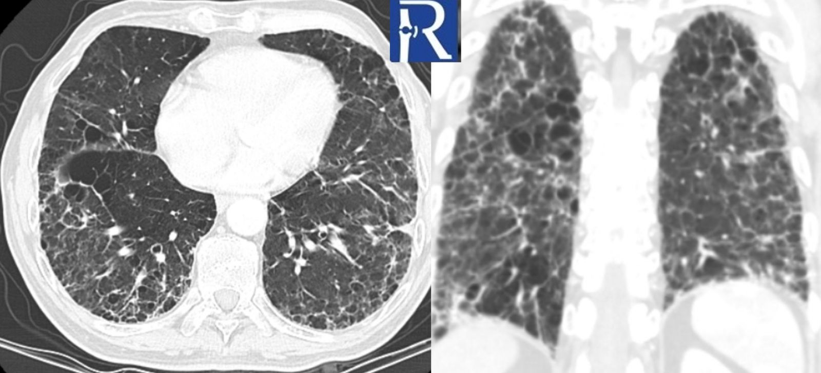 Thoracic CT demonstrates widespread subpleural thickening, reticular opacities, and a mild honeycombing pattern in both lungs.