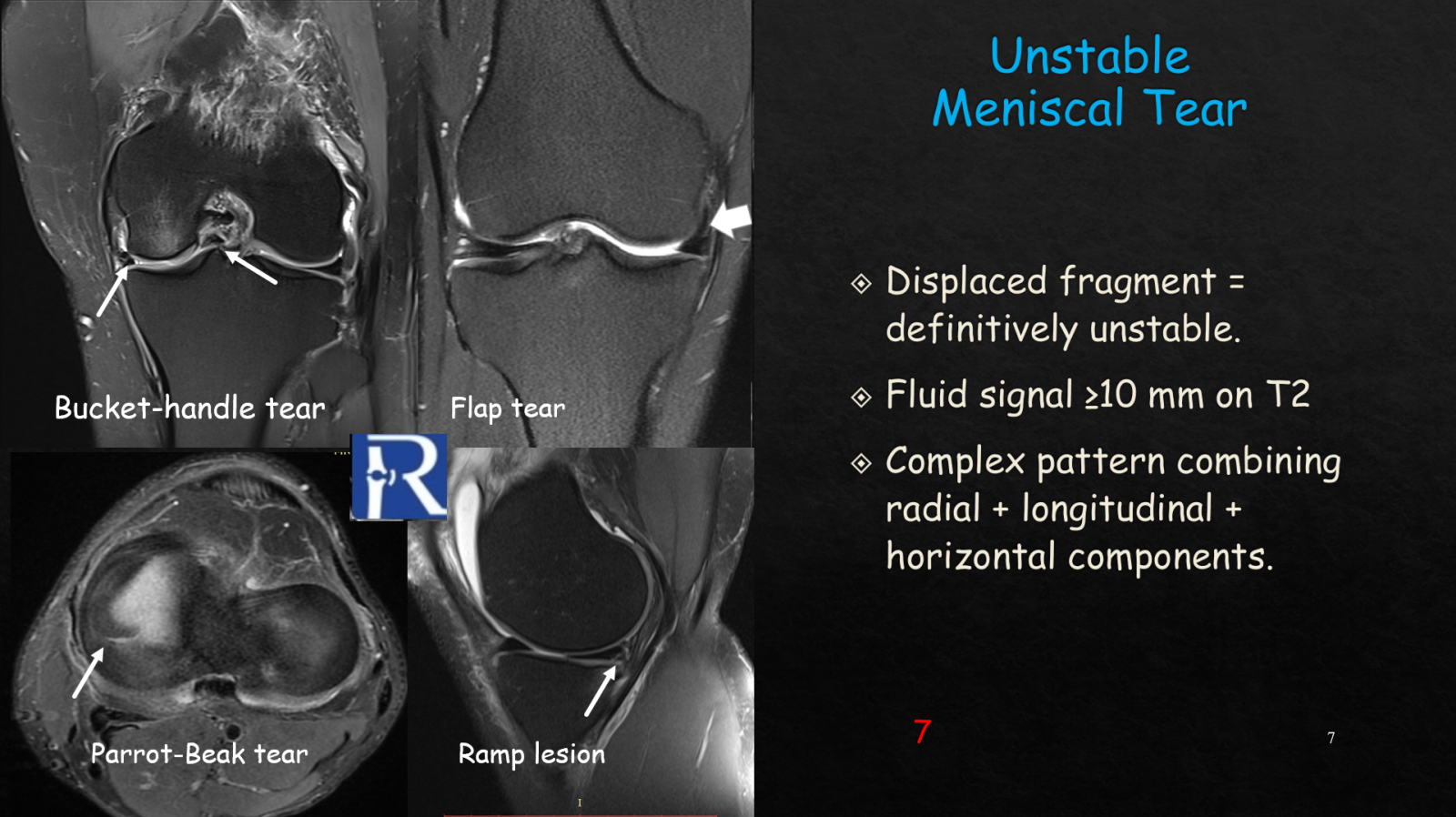 Meniscal Tears – Comprehensive MRI Guide