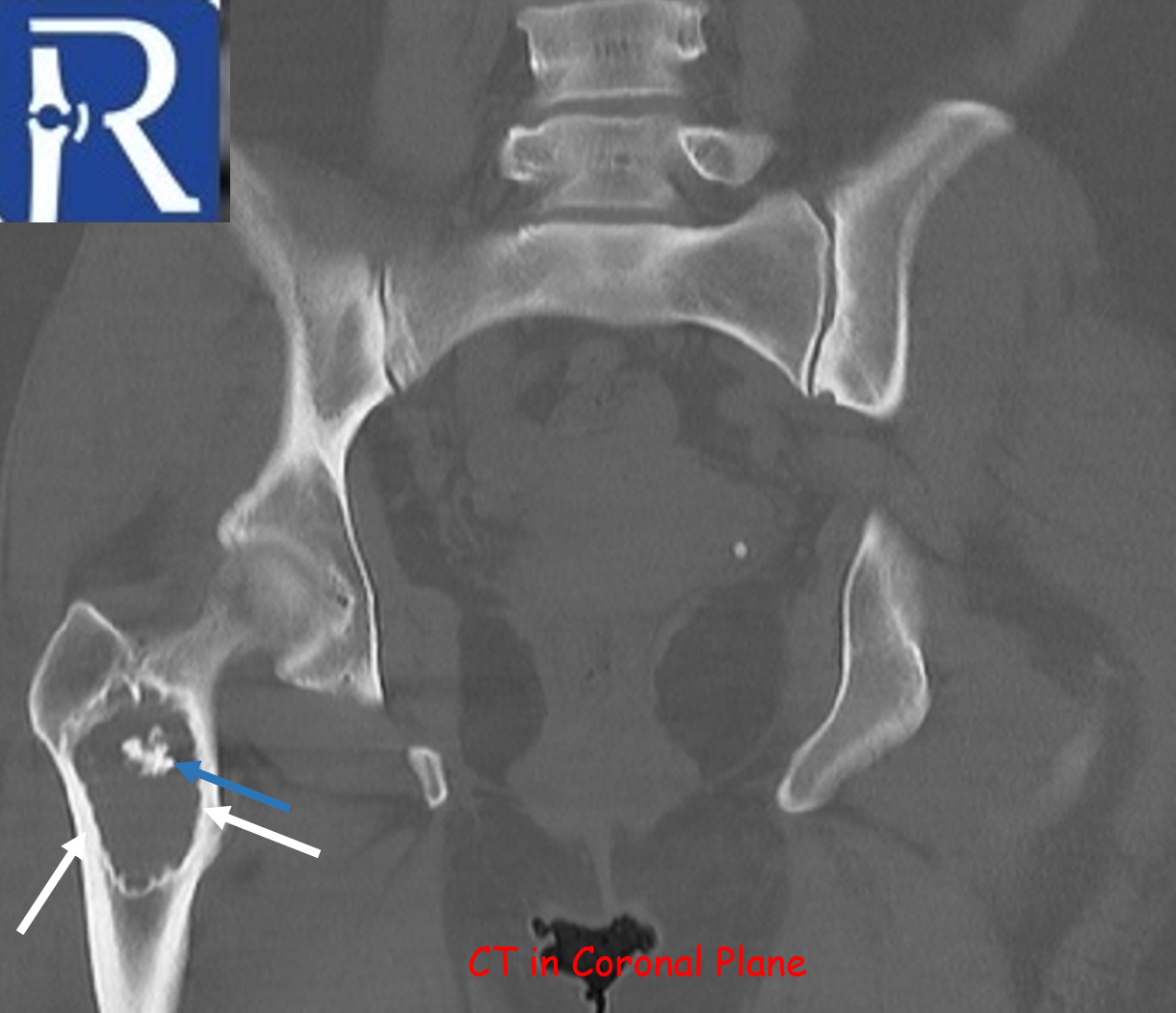 Liposclerosing Myxofibrous Tumor; Typical Location, Classical ...