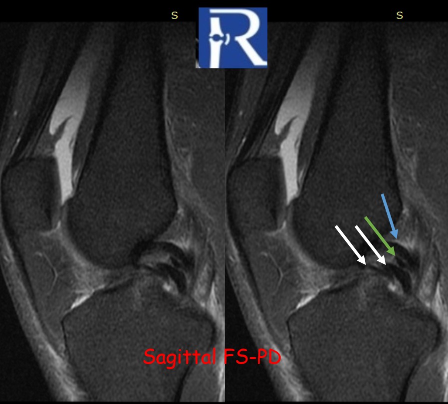 Quadruple PCL Appearance: An Undescribed MRI Sign of Bucket-Handle Tear?