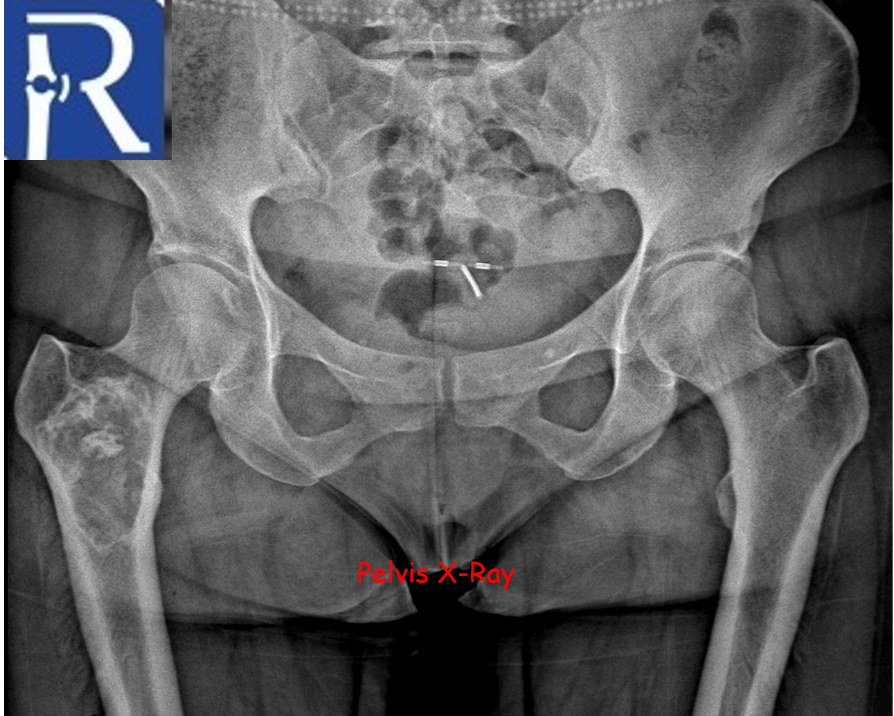 Liposclerosing Myxofibrous Tumor; Typical Location, Classical Radiologic Features