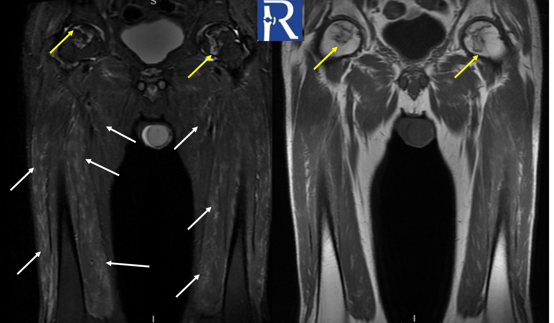  MR Features of Dermatomyositis with Pulmonary Involvement