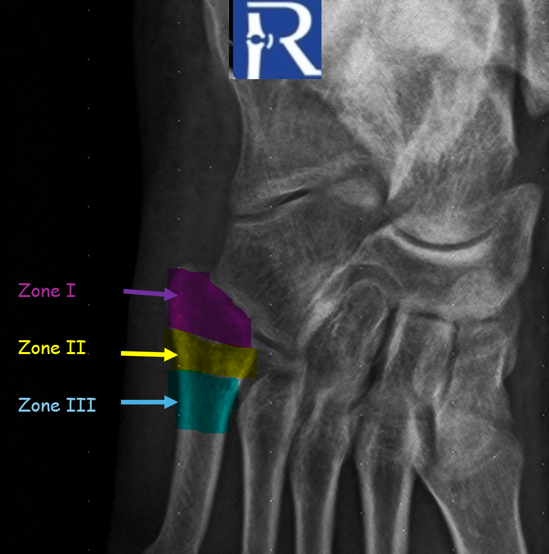 Diagnostic Value of Multiplanar Imaging in Fracture Evaluation: Pseudo-Jones Fracture