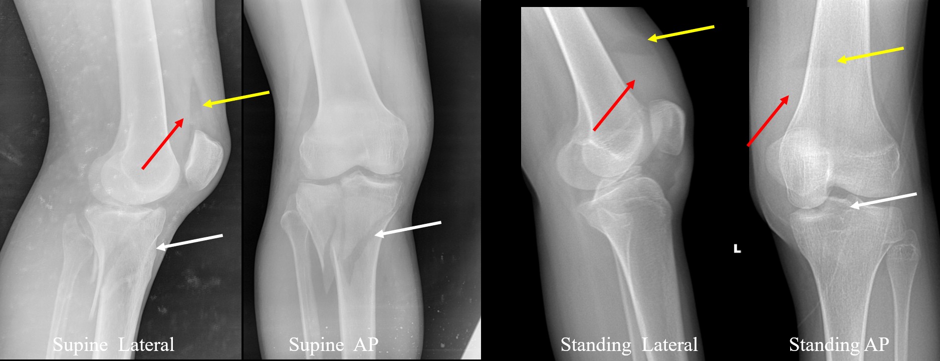 Fat–Fluid Leveling in Acute Knee Trauma: A Critical Red Flag for Intra-Articular Fracture