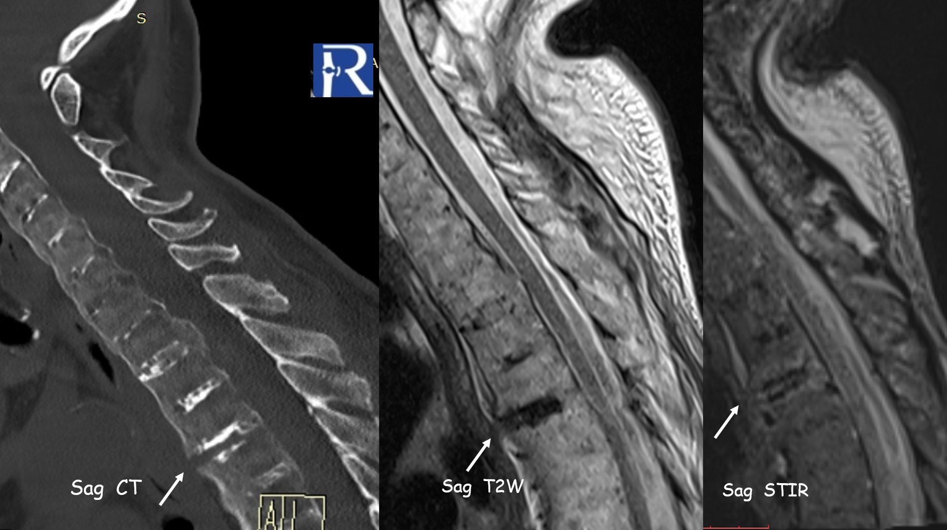Chalk-Stick Fracture in Ankylosing Spondylitis 
