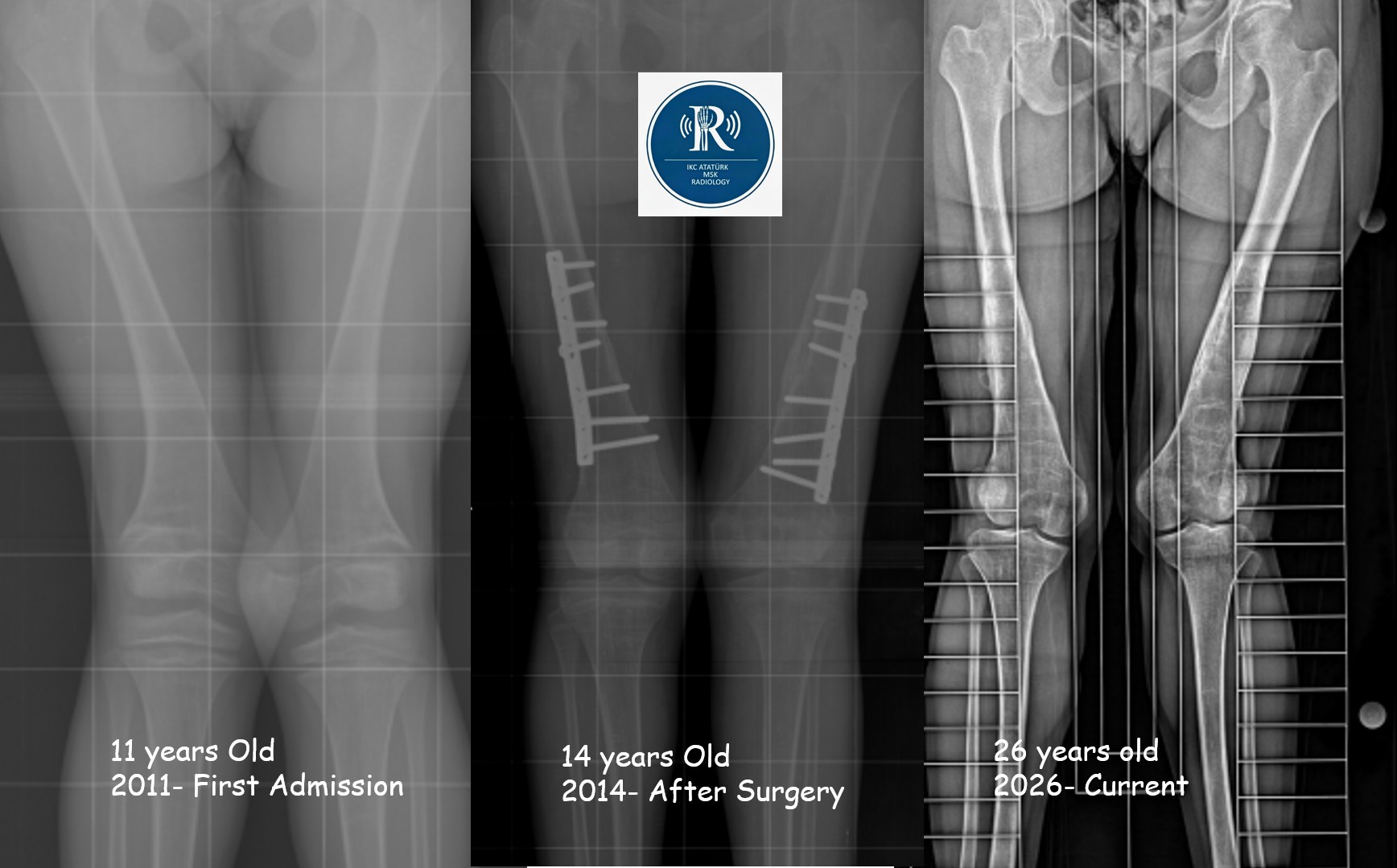 Long-Term Sequelae of Childhood Rickets Manifesting as Patellofemoral Instability in Adulthood: A 15-Year Imaging Follow-Up