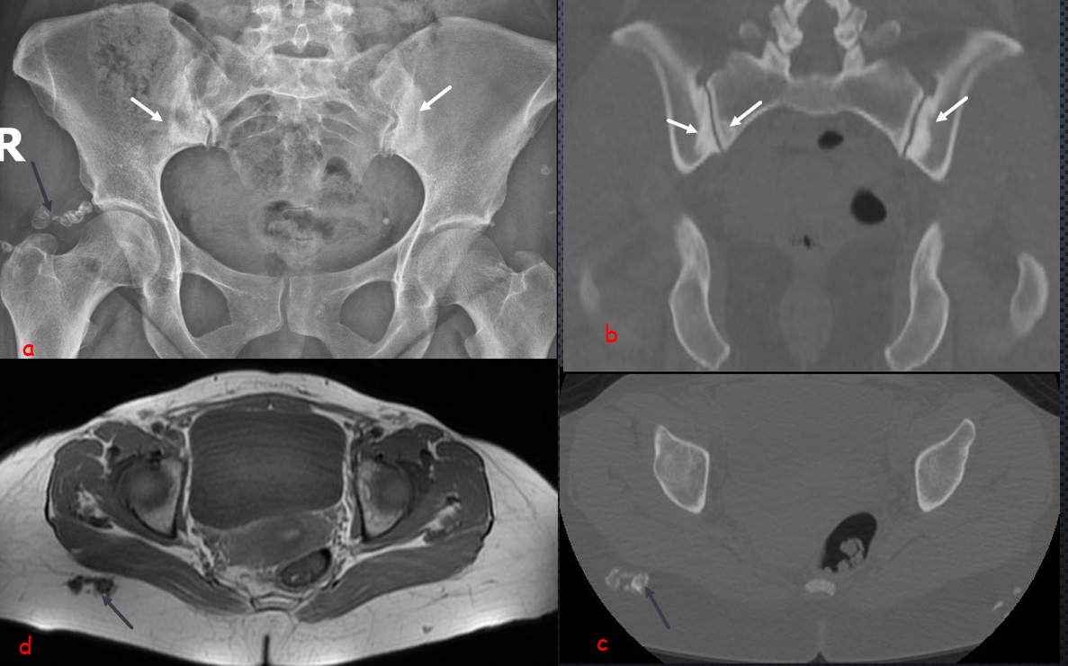 Osteitis Condensans Ilii Radiology Mri