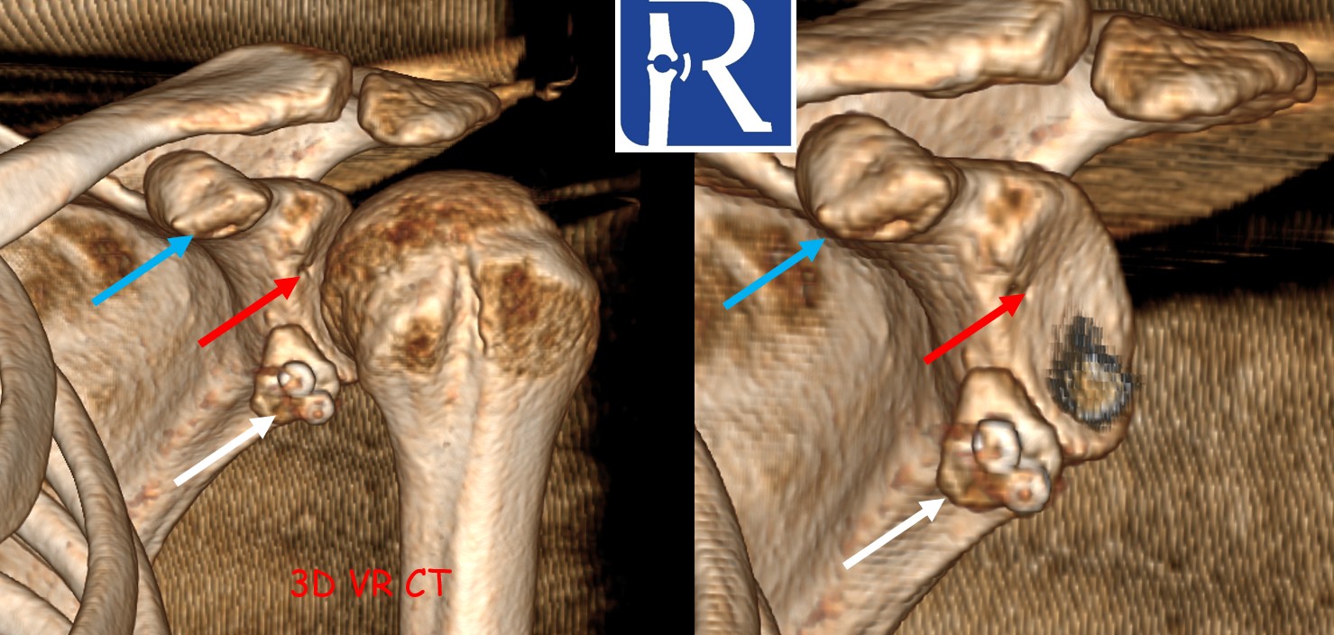 Decoding the Operated Shoulder — Sagittal Plane Secrets (Latarjet Case)