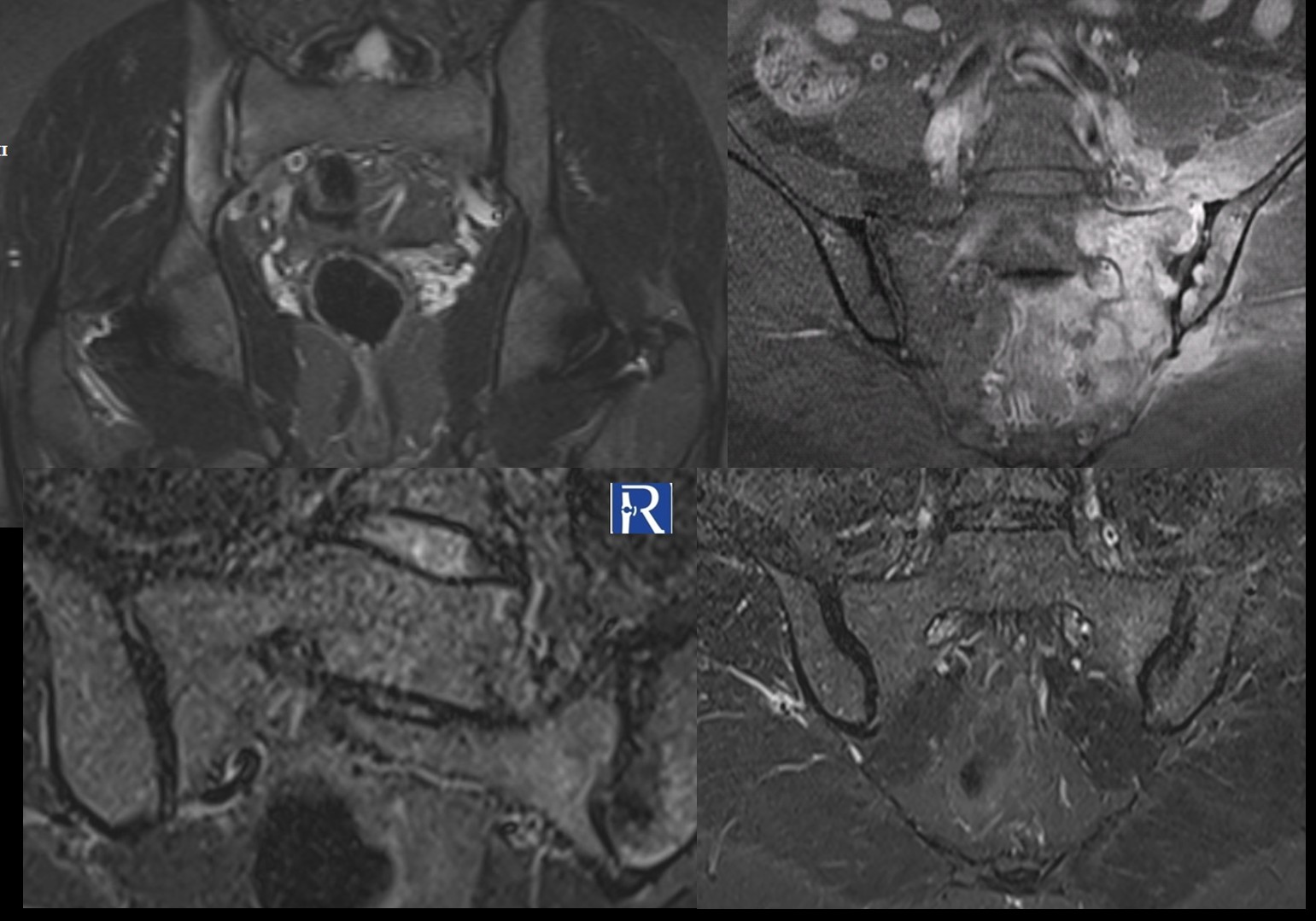Sacroiliitis on MRI: Imaging Features and Differential Diagnosis