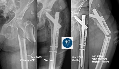 Not Only Bone Breaks: Implant Failure in Atypical Femoral Fracture