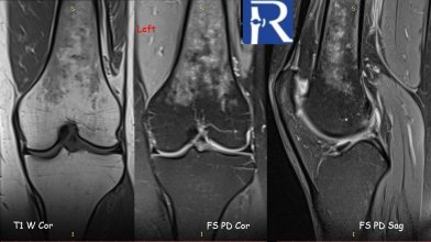 Bone Marrow Involvement in Sarcoidosis
