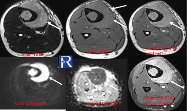 Primary Bone Lymphoma of the Tibia: “The Chameleon Lesion of Bone” Mimicking Ewing Sarcoma on MRI