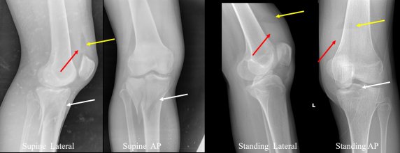 Fat–Fluid Leveling in Acute Knee Trauma: A Critical Red Flag for Intra-Articular Fracture