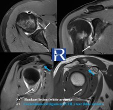 Recurrent Shoulder Dislocation and Coracohumeral Ligament Tear: Beyond Bankart and Hill–Sachs