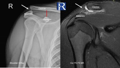 When the Upper Limb Disconnects from the Trunk: Grade 3 Acromioclavicular Joint Separation with Coracoclavicular Ligament Rupture (Rockwood Type III