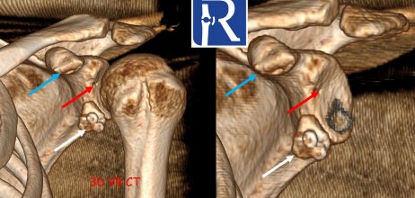 Decoding the Operated Shoulder — Sagittal Plane Secrets (Latarjet Case)