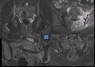 Sacroiliitis on MRI: Imaging Features and Differential Diagnosis